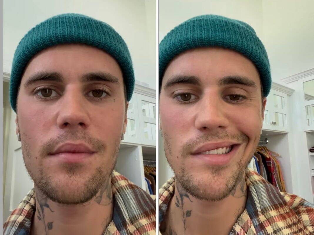 Justin Bieber Appears With His Face Paralyzed And Reveals Ramsay Hunt Syndrome Jetss